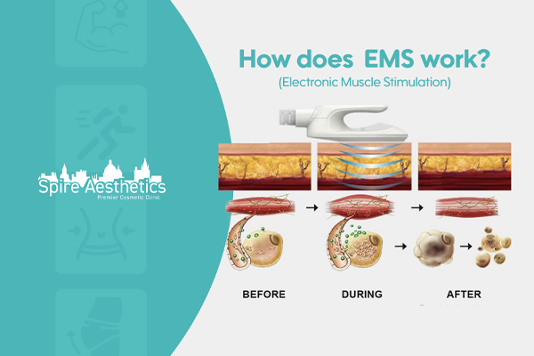 EMS treatment for post pregnancy weight loss treatment Hampshire