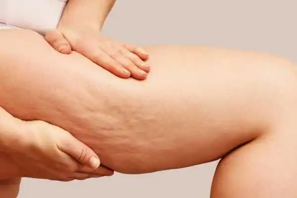Image of woman showing leg with cellulite Hampshire