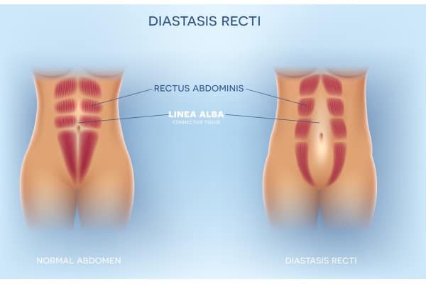 What Non-Surgical Options Are Available for Diastasis Recti Hampshire?