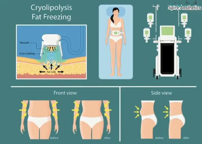Fat freezing treatment Hampshire benefits for competitions to remove stubborn fat deposits.