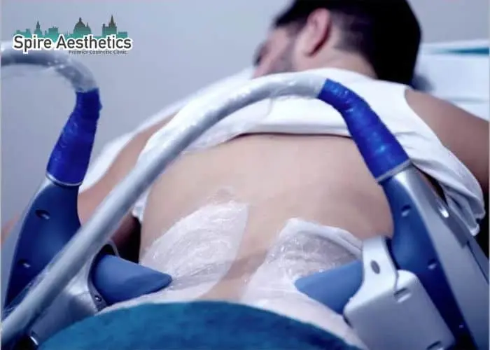 Man having fat freezing treatment done on love handles before a competitions Hampshire to create a sculpted look.