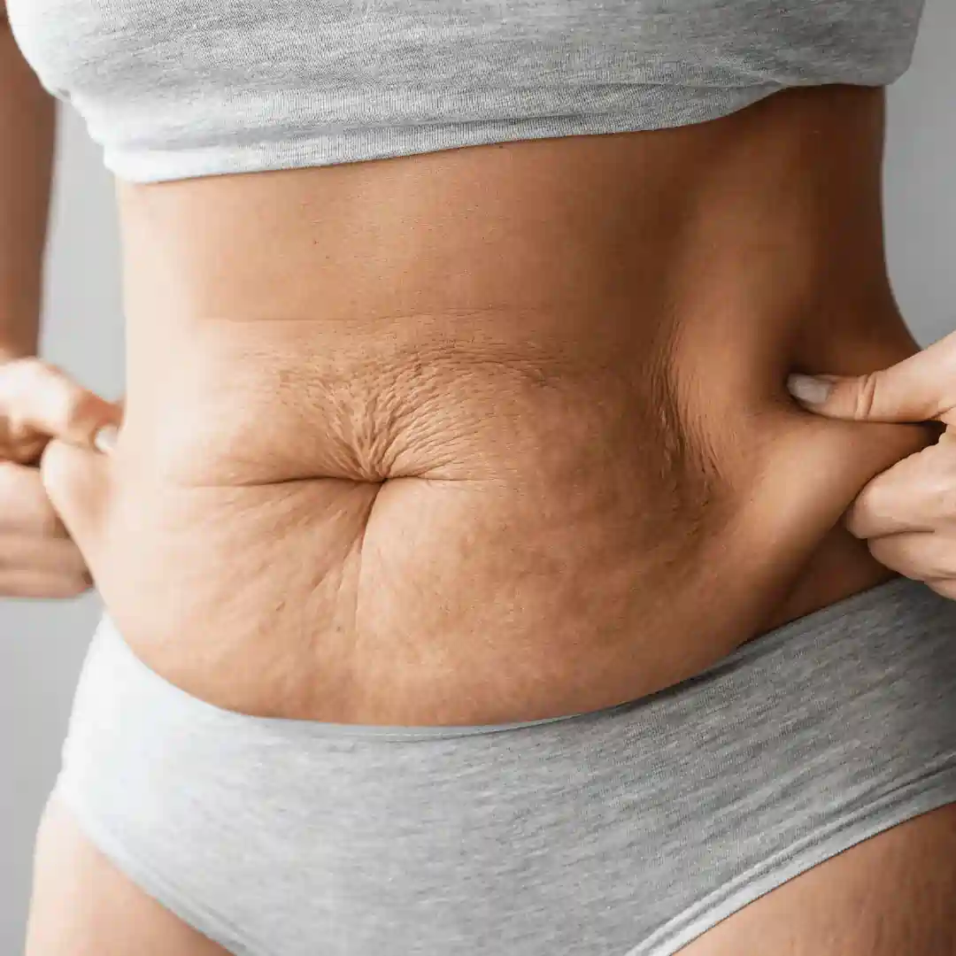 Is It Normal to Have Loose Skin After Pregnancy Hampshire?