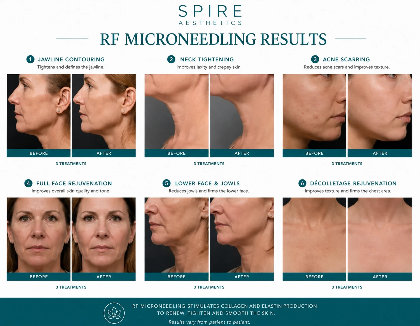 RF Microneedling Skin tightening Hampshire results
