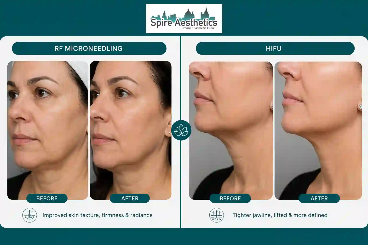 Can RF Microneedling and HIFU Be Combined Hampshire?