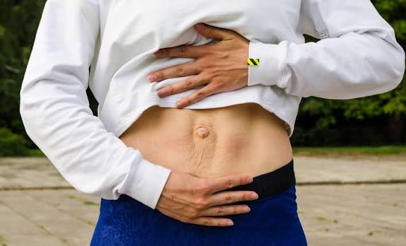 When Could Diastasis Recti Be the Missing Piece of the Puzzle Hampshire?