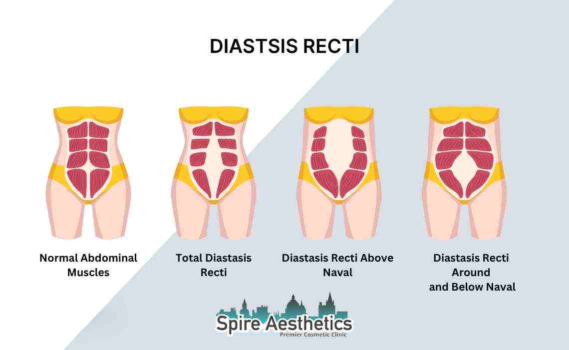 Is Non-Surgical Diastasis Recti Treatment Right for You? Common Concerns Answered Hampshire